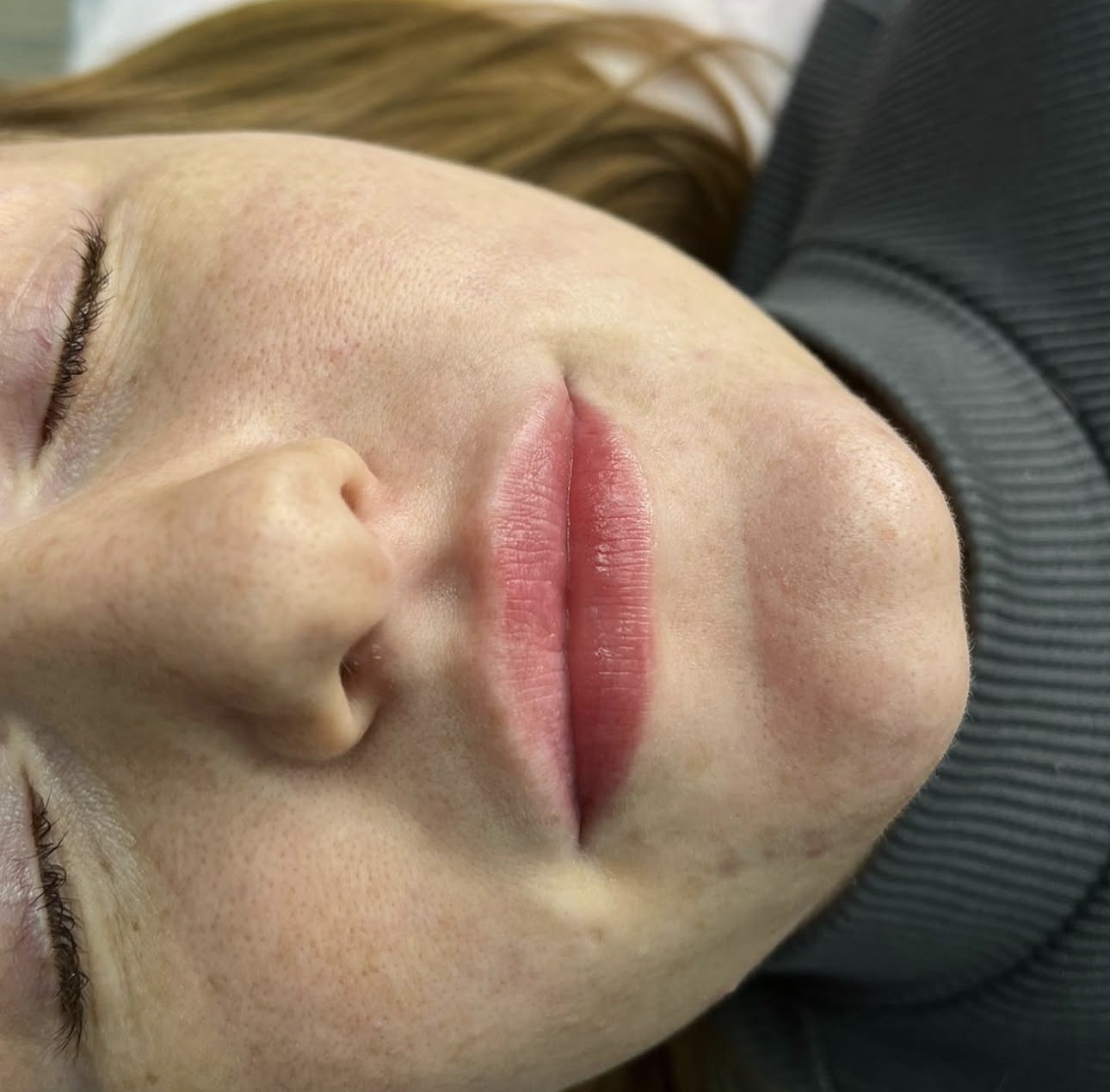 Lips before filler treatment